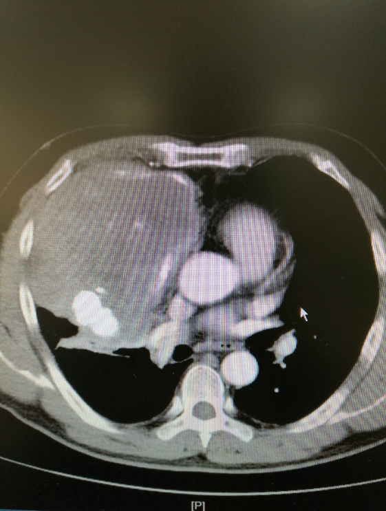 我院中西医结合外科胸外团队完成1例巨大纵膈肿瘤切除手术